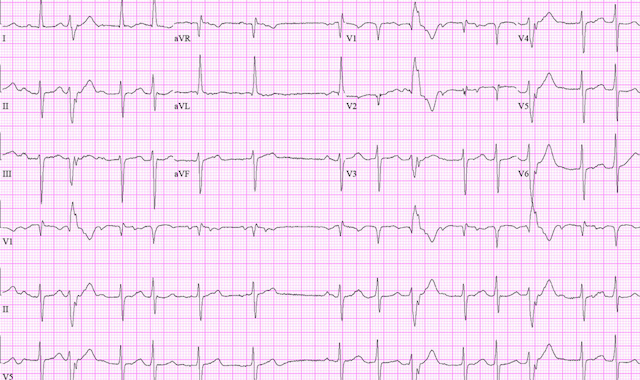 ECG computer print out of atrial fibrillation in an older women