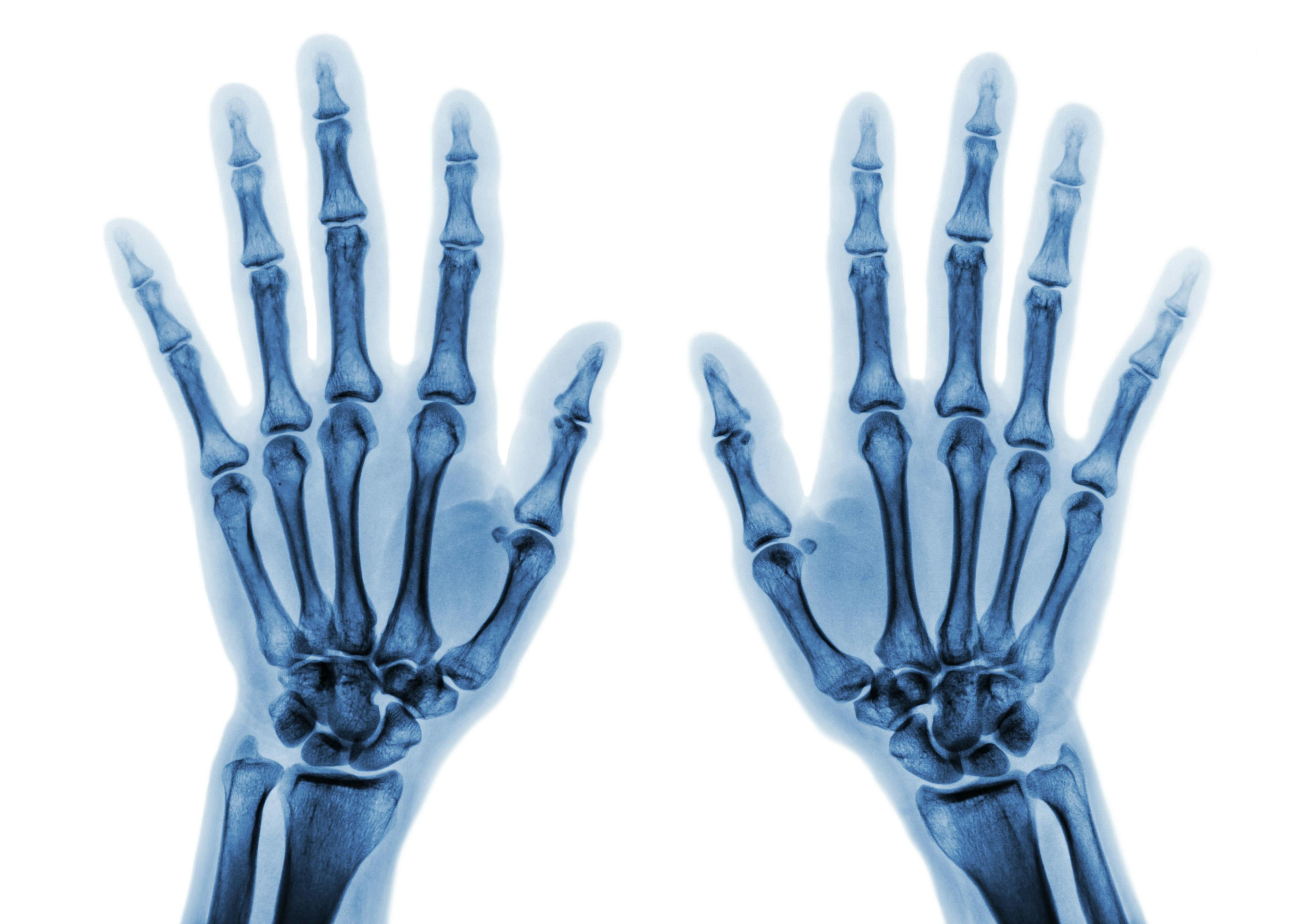Long-Term Cumulative Joint Inflammation Linked to Joint Damage Progression in Rheumatoid Arthritis 