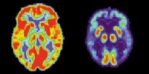 Diabetes Significantly Increases Dementia Risk
