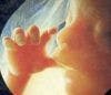 Effects of Antiepileptics on Unborn Babies
