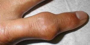 Gout Associated With Increased Risk of Cancer