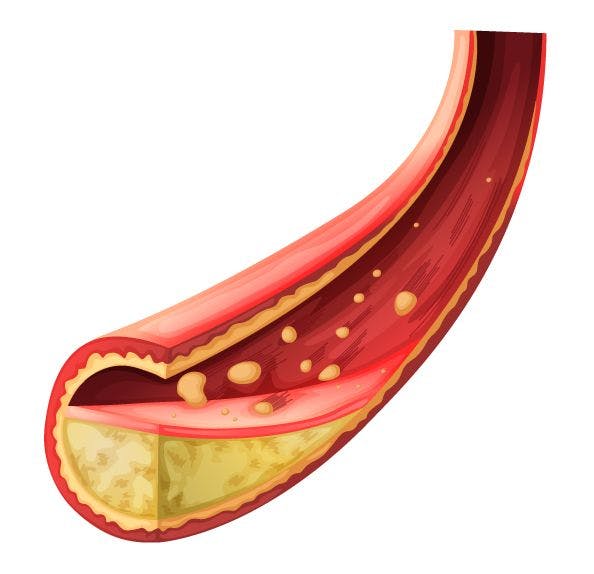 (Artery blocked with cholesterol ©BlueRingMedia/Shutterstock.com)