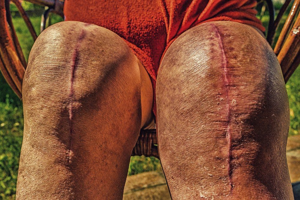 (Post-op knee replacement ©GoneWithTheWindShutterstock.com)