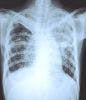 Isoniazid Intervention Reduces Tuberculosis, Death in HIV Patients