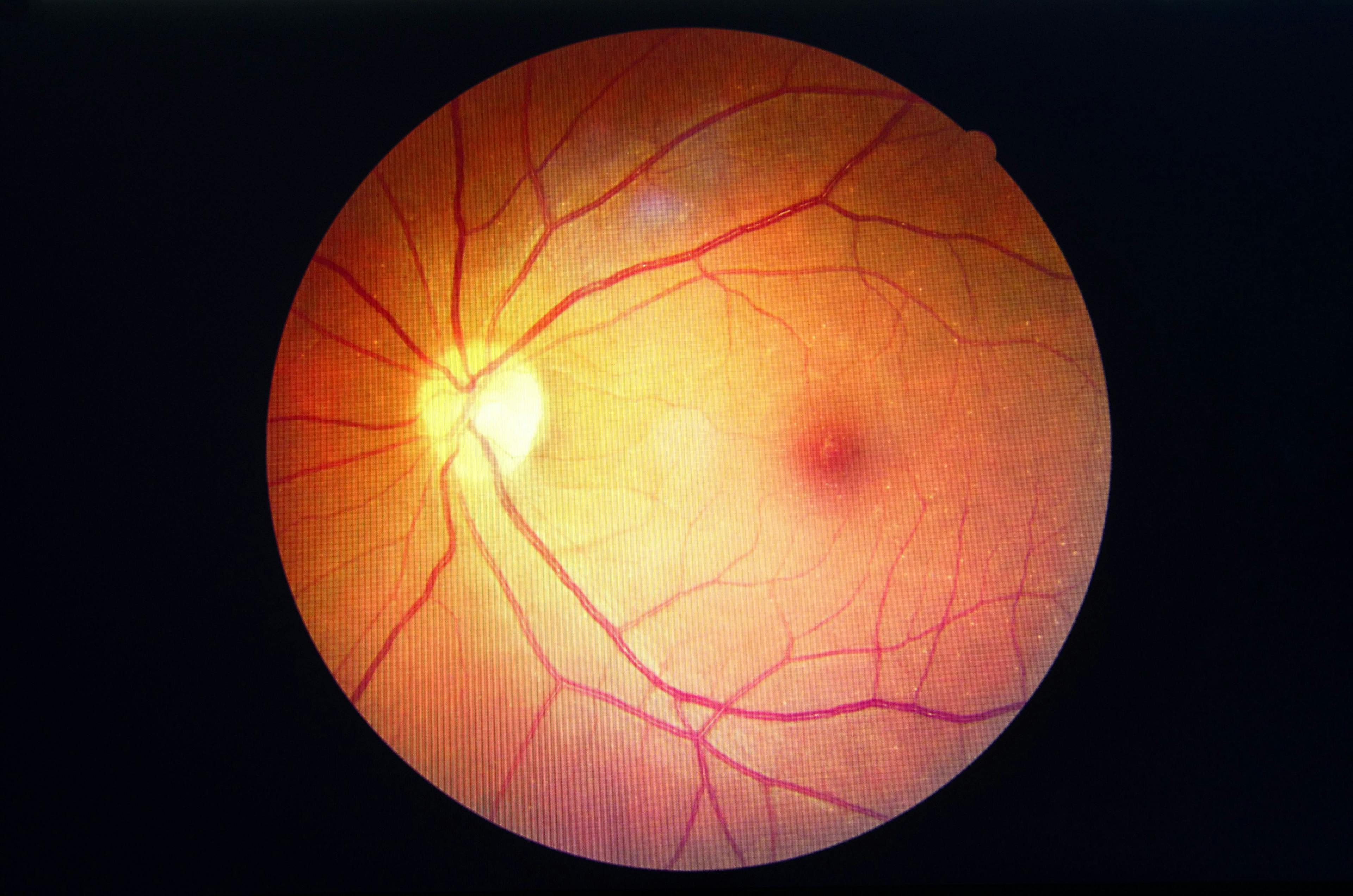 Retinopathy in Systemic Lupus Increases with Longer Hydroxychloroquine Use
