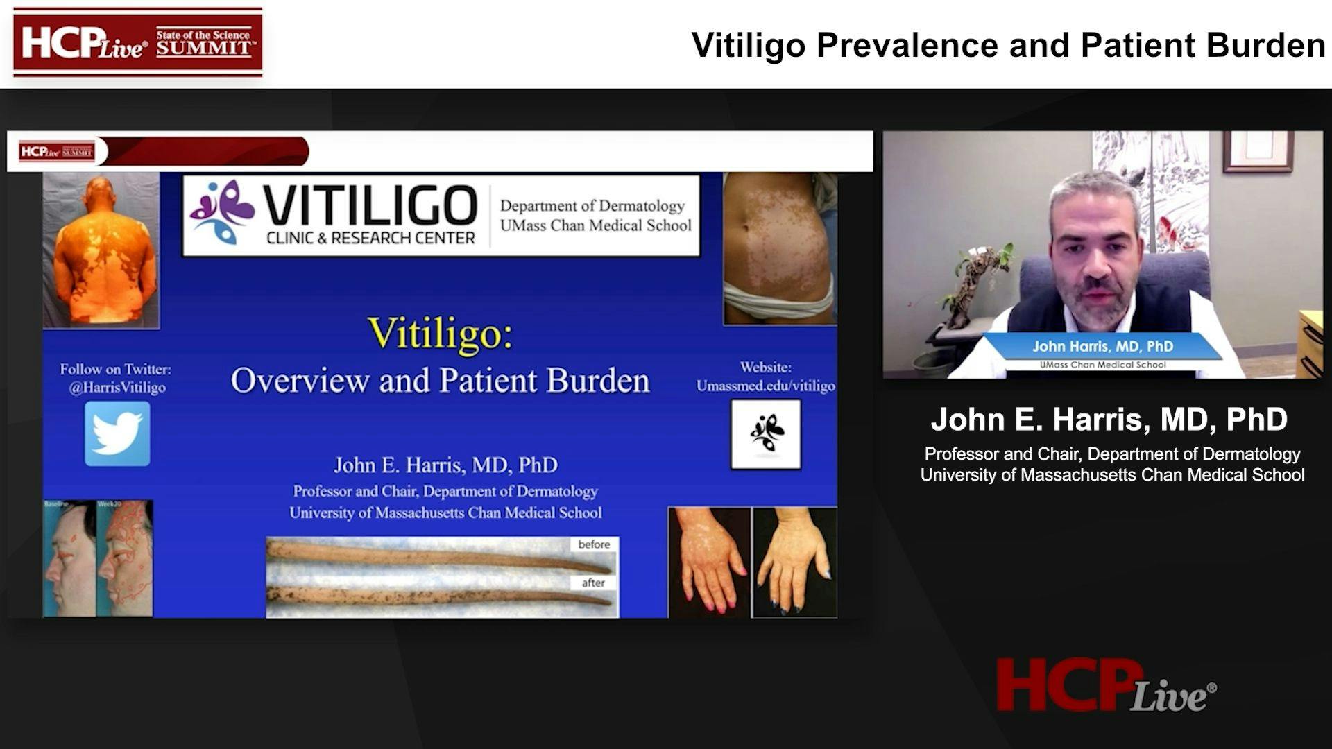 Vitiligo Prevalence and Patient Burden