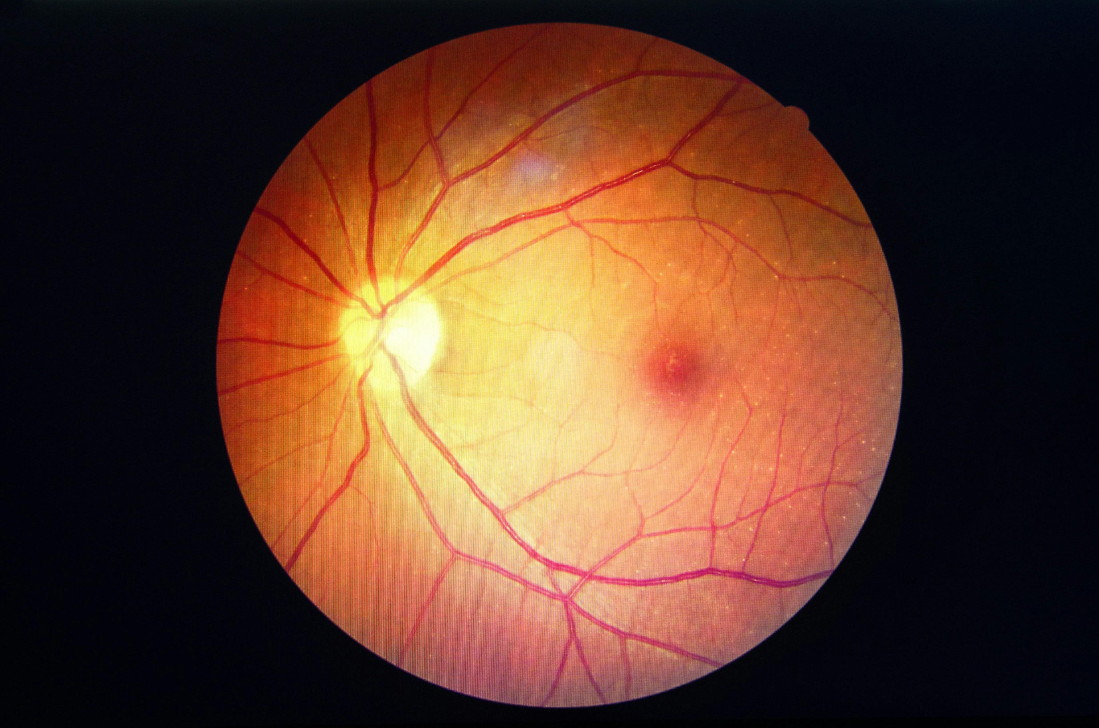 Hydroxychloroquine retinopathy in lupus patients. 