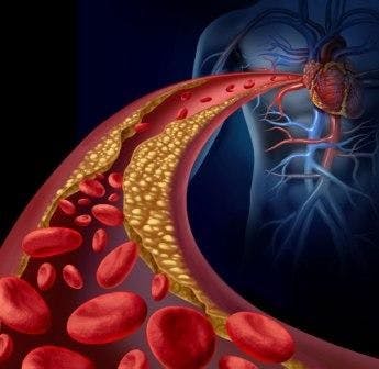 Low T and cardiovascular disease in type 2 diabetes