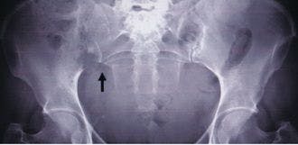 A Russian Bride With Hip Pain