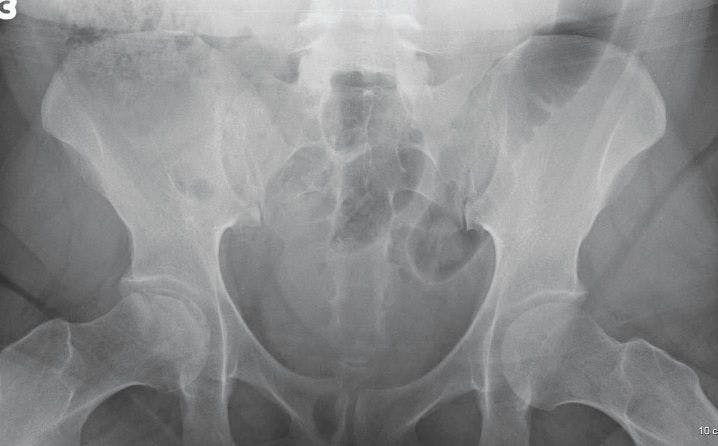 Hip Pain in a Patient With Lupus