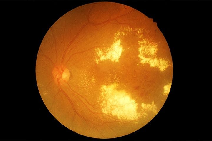 Online Information on Diabetic Retinopathy Varies in Accuracy, Quality