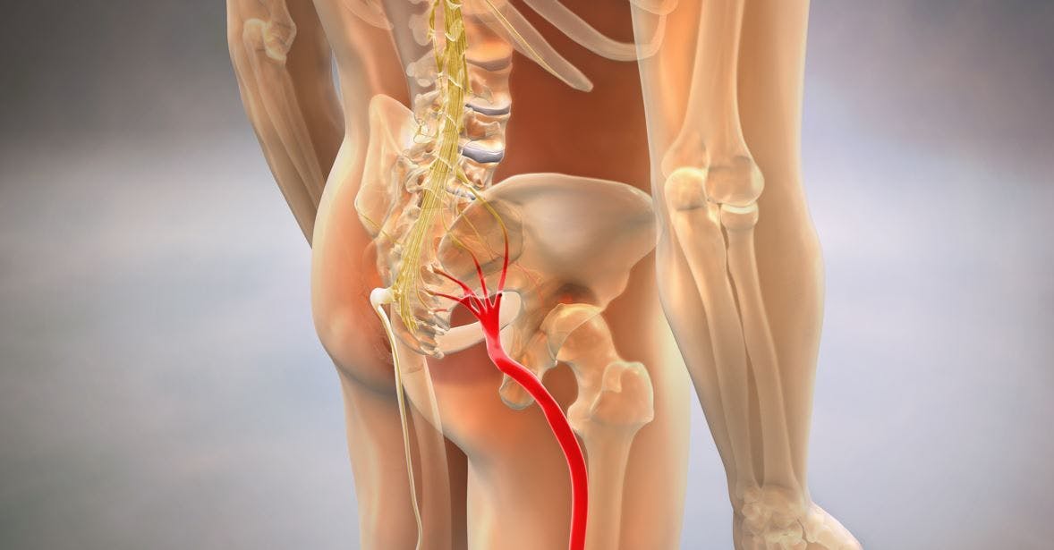 Surgery better than exercise for leg pain sciatica