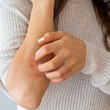 High Prevalence of Pruritus Recorded in Patients with Psoriasis