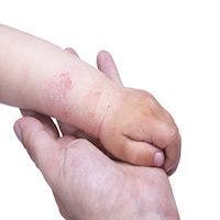 Dermatologists Say Kids with Eczema Can Shower Every Day