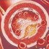 Atherosclerosis: Patient-education Videos