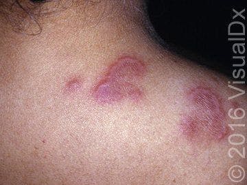 Image IQ:  Smooth plaques with pain and itch