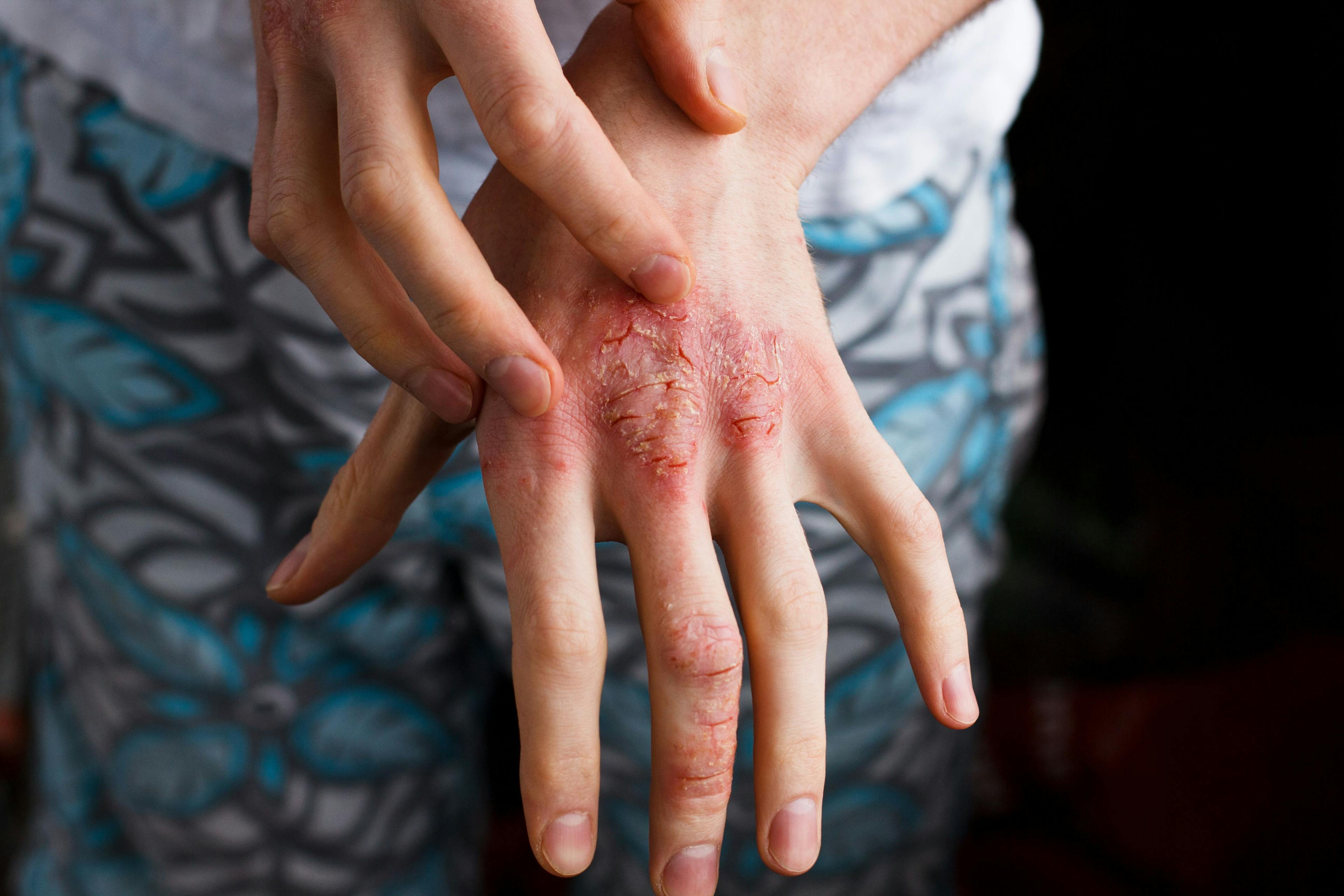 Switching to a Biosimilar from an Originator Deemed Safe and Effective in Psoriasis Treatment