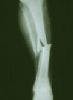 Bone fracture X-ray