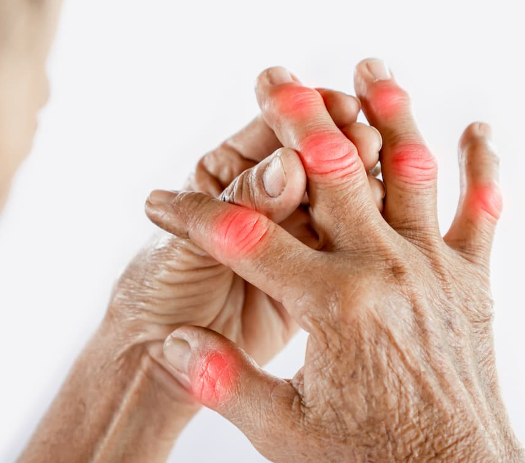 Study Evaluates SIRI as a Potential Inflammatory Marker in Gouty Arthritis