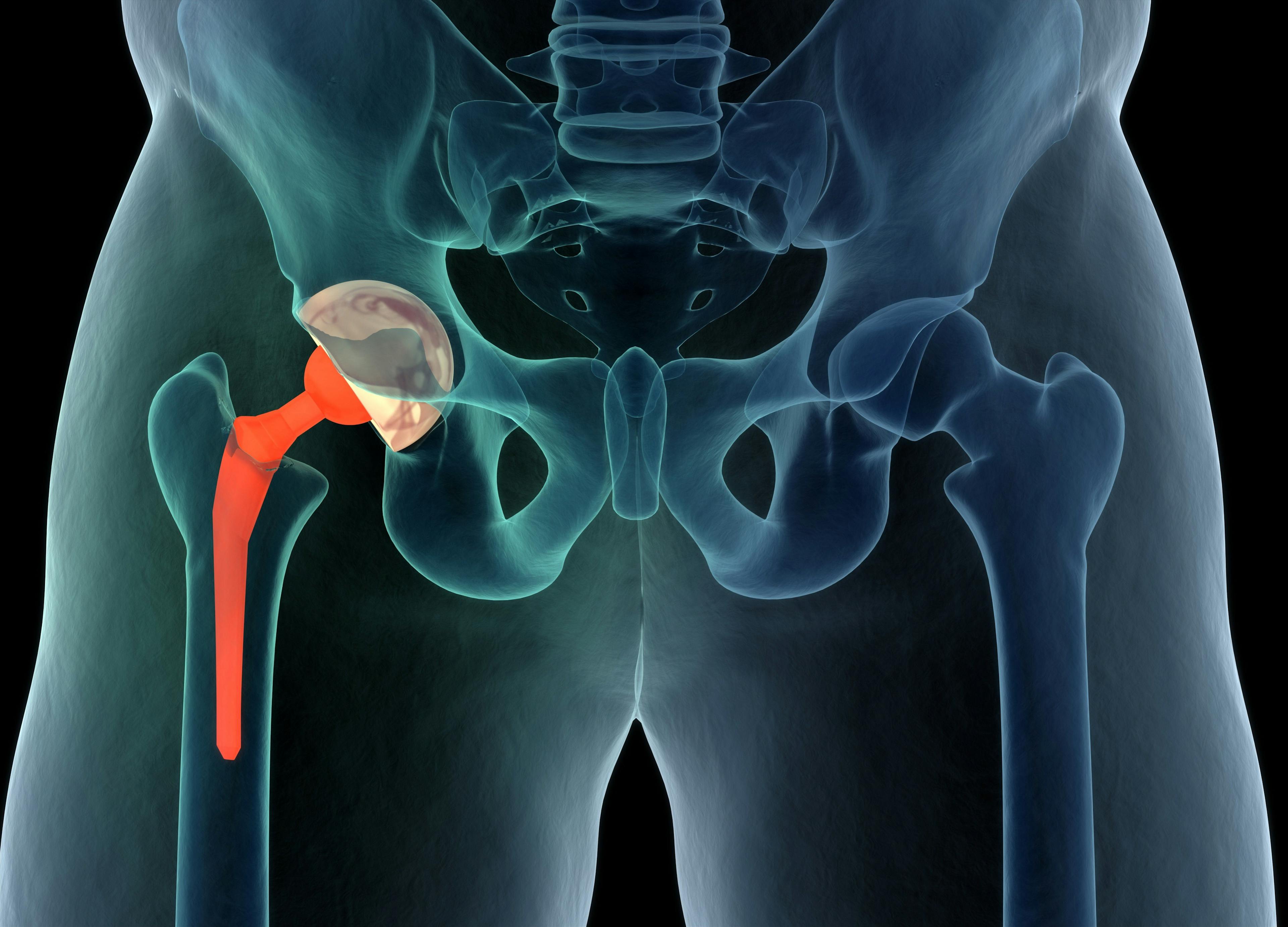 Hip replacement (©AdobeStock_Anatomy Insider)