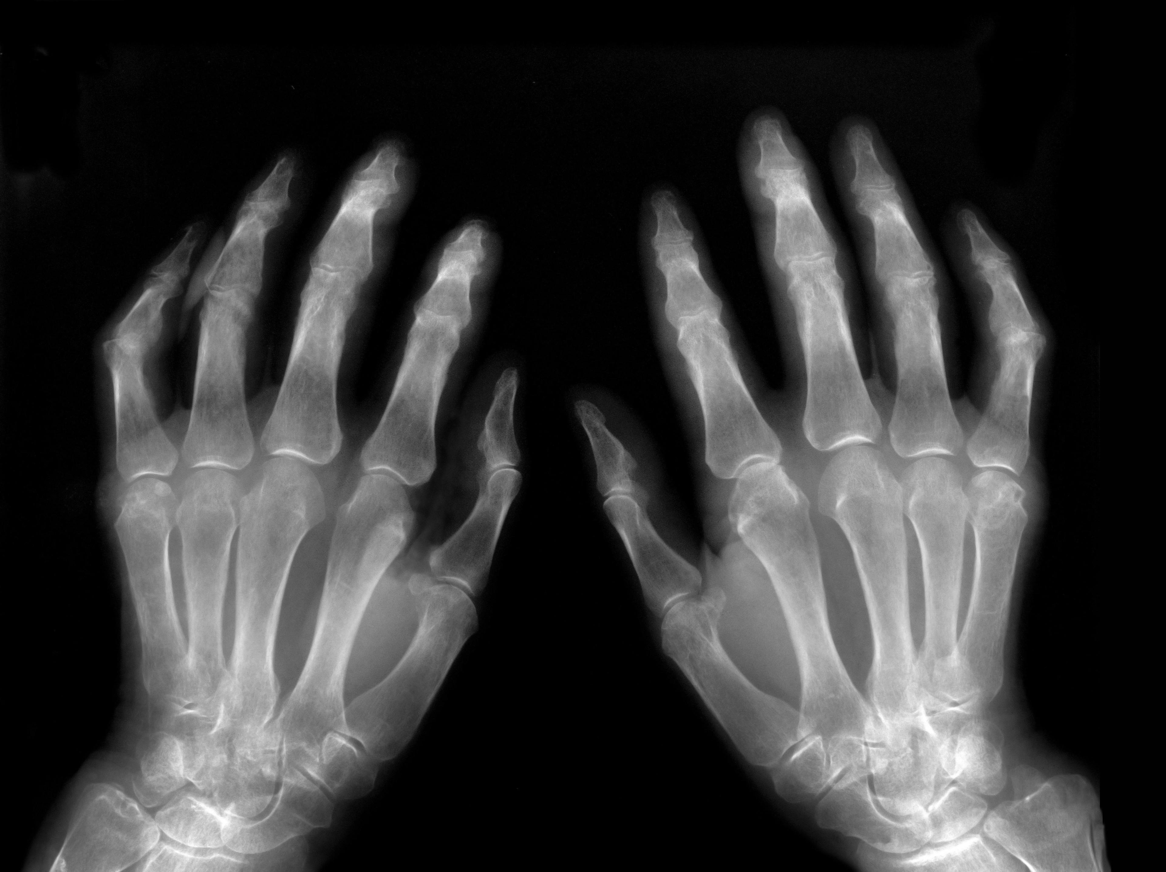 Fluorescence Optical Imaging Shows Potential in Rheumatoid Arthritis