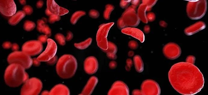 Early Momentum for a Genomic Approach to Sickle Cell Disease Therapy