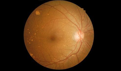 retinal thinning, AMD, reticular pseudodrusen, OCT, optical coherence tomography, macular degeneration