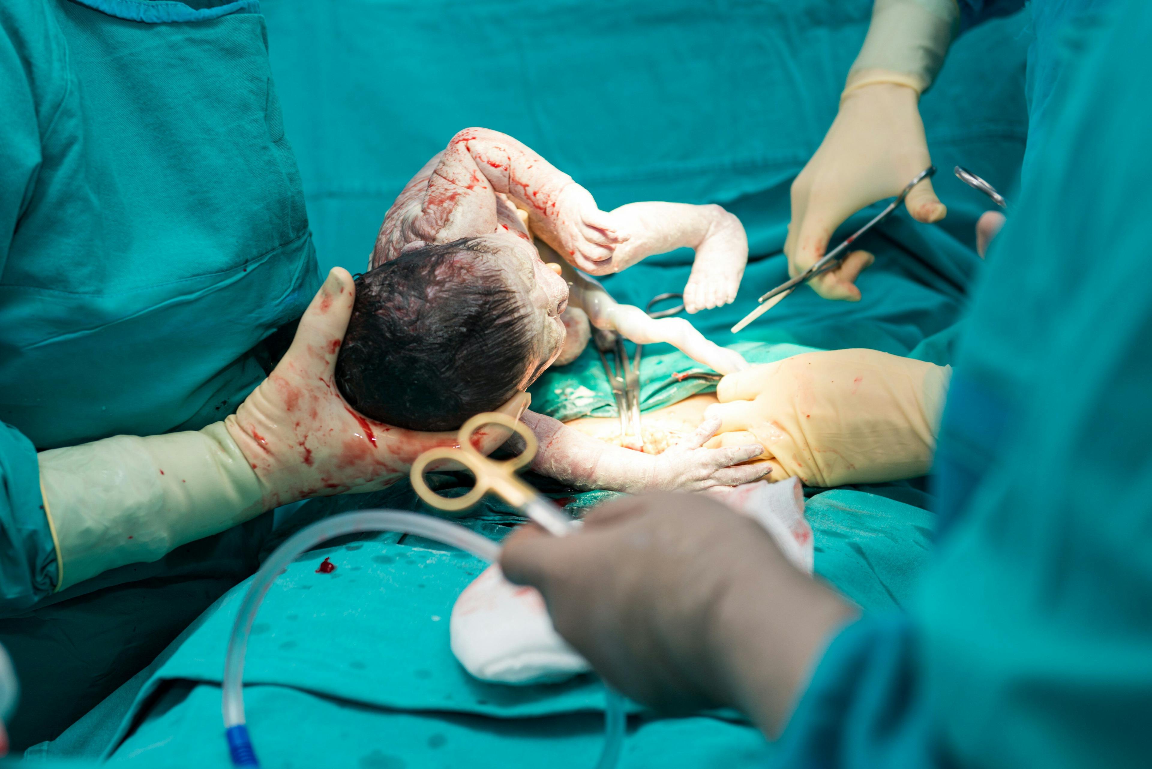 Being Born by Cesarean Increases Odds of Obesity and Diabetes 