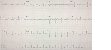 EKG read of a patient. 
