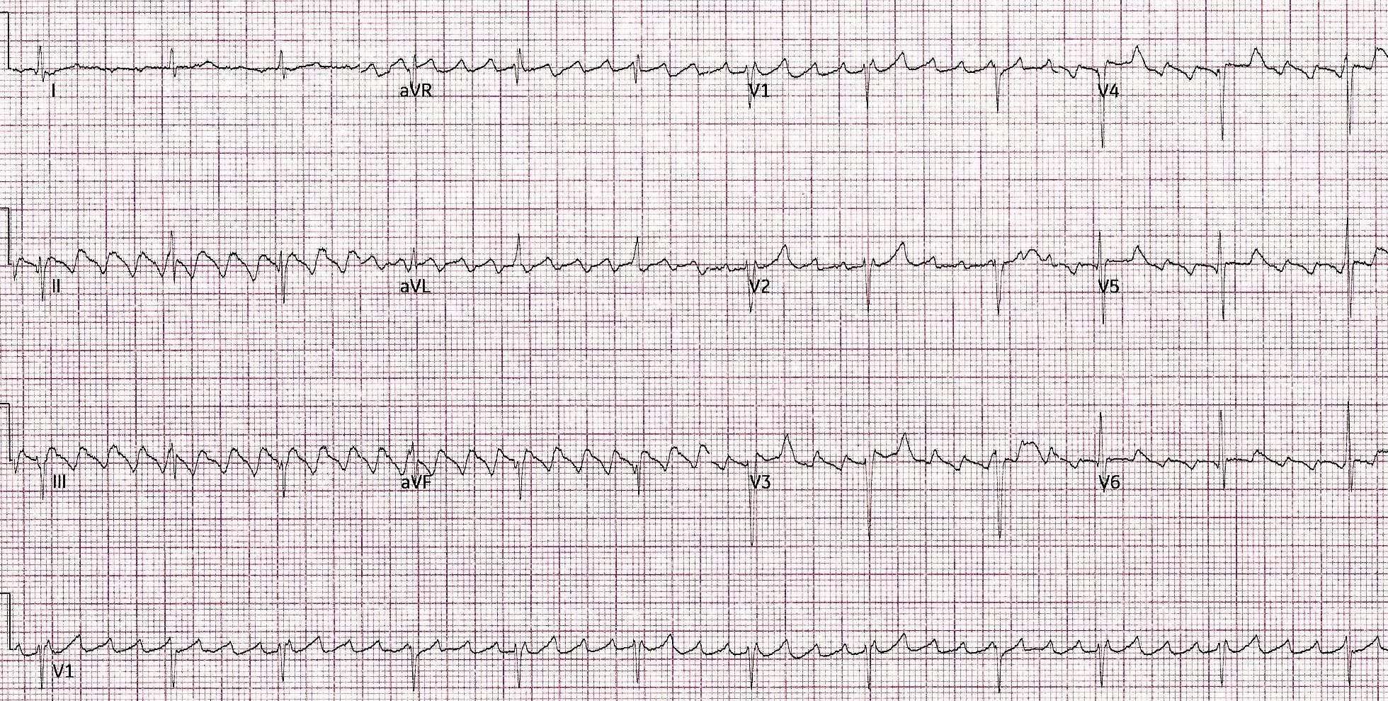 ECG printout from a patient featured in a case report | Credit: Brady Pregerson, MD