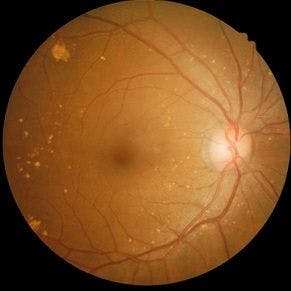 Retinal Thinning May Be Linked to Vascular Alterations in AMD Patients