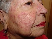 Clinical Review: Brimonidine Gel for Treatment of Facial Erythema in Rosacea Patients