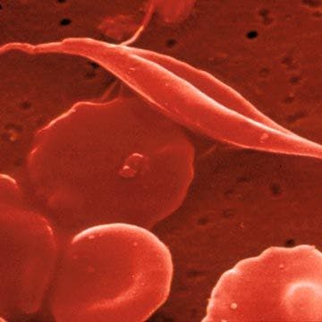 Physicians Reluctant to Treat Pain in Children with Sickle Cell Disease 