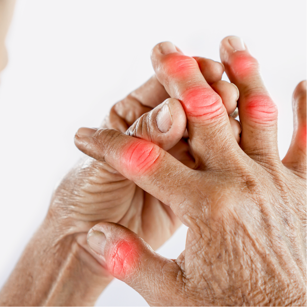 Certain Antihypertensive Drugs may Increase Risk of Hyperuricemia, Gout