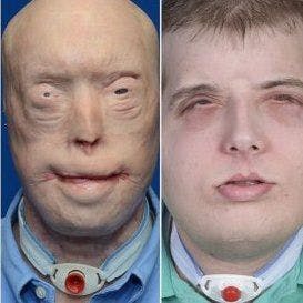 NYU Langone Surgeon Completes Most Extensive Face Transplant Ever