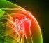Shutting off Immune System Signal May Lead to Better Arthritis Treatments