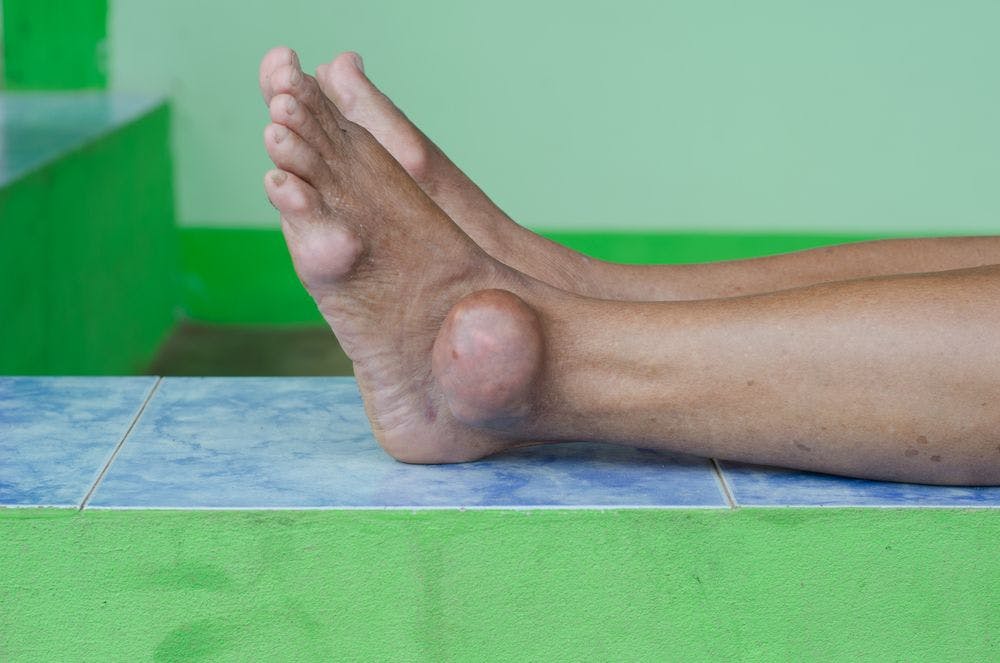 Failure to Lower Serum Urate in Gout Linked with Mortality