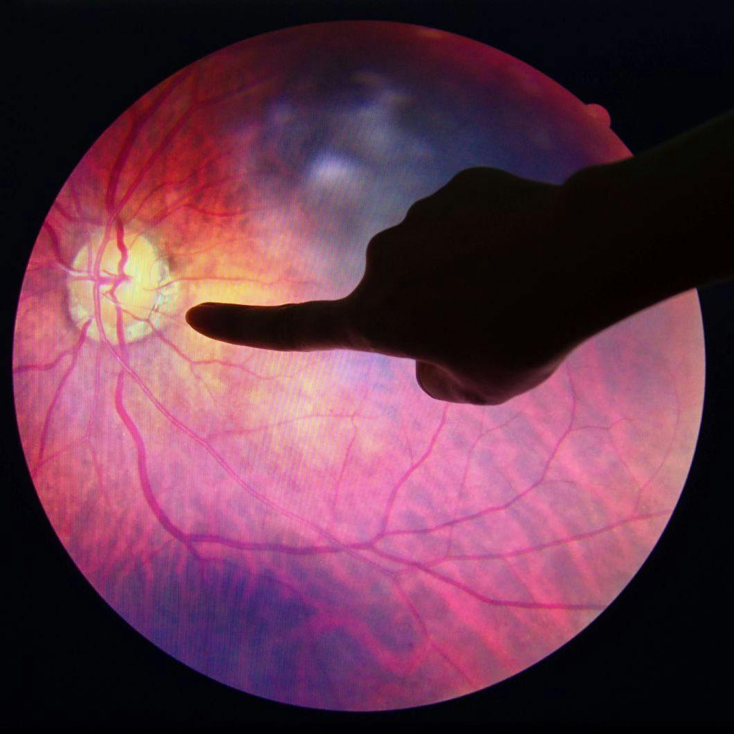Potential Lipid Biomarkers for AMD Identified in Human Plasma
