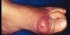 Gout Prevalence Swells In US Over Last Two Decades
