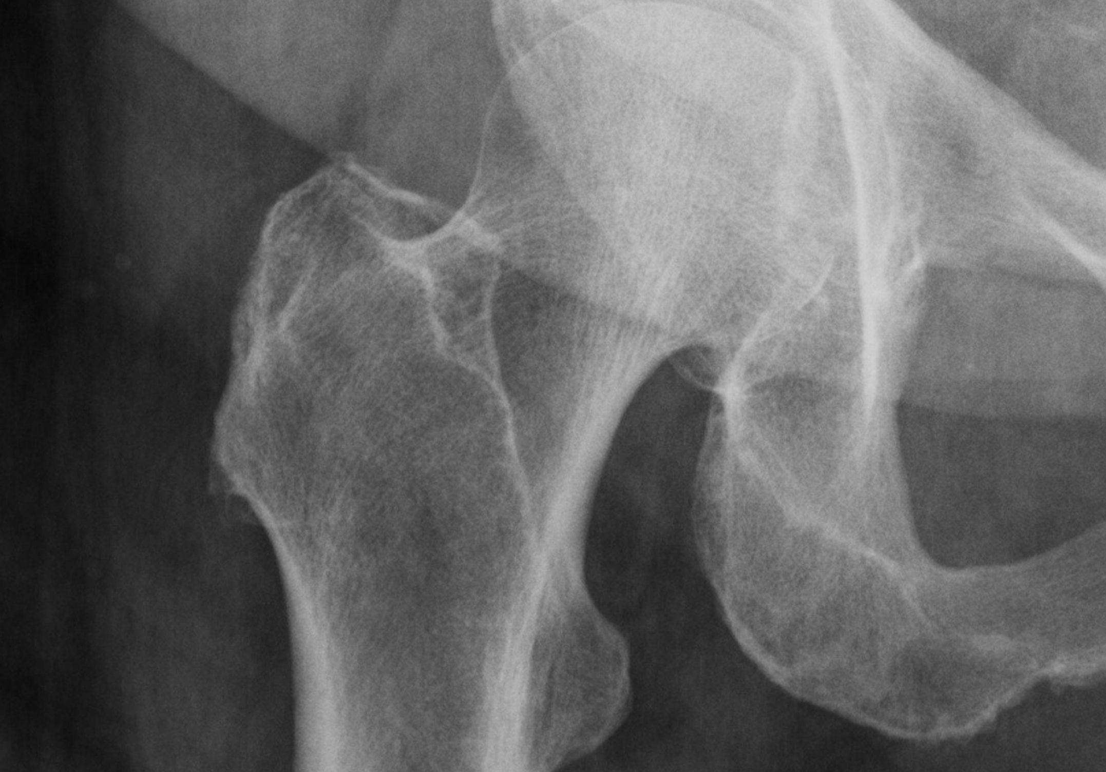 FRAX Score Improves Secondary Fracture Prevention