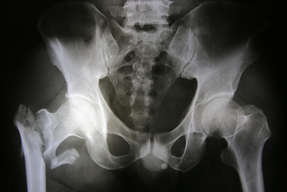 X-Ray, Hip and Pelvis (©Phenyx7776Shutterstock.com)