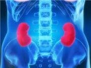 Math Model Can Predict Severity of Kidney Damage in Lupus Patients