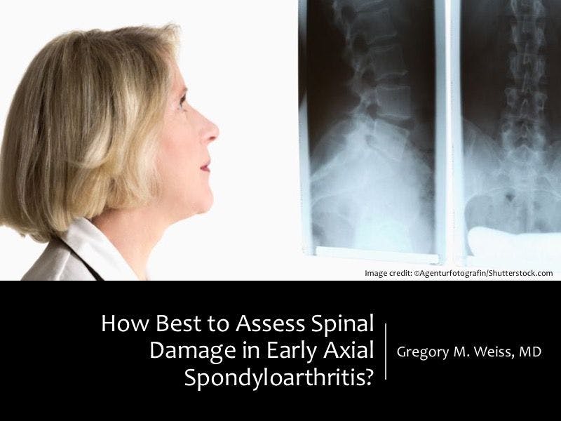 How Best to Assess Spinal Damage in Early Axial Spondyloarthritis?
