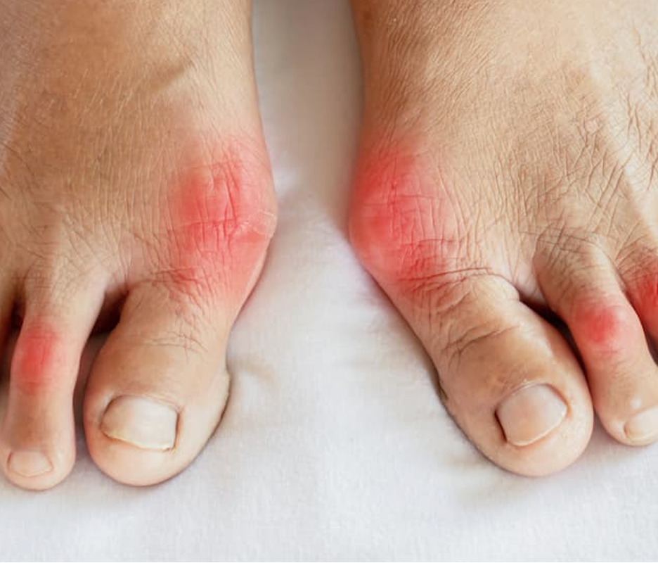 Incidence of Gout did not Significantly Increase in Patients With Thalassemia 