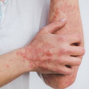 Skin Disease Shown to Significantly Impact Daily, Work Lives Among Patients in Europe