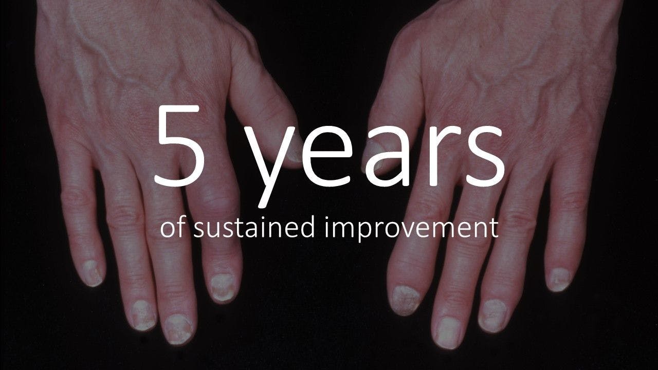 Secukinumab Benefits in Psoriatic Arthritis Persist for 5 Years