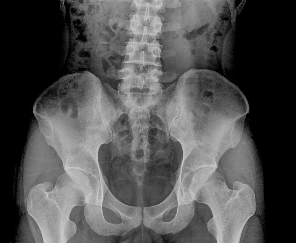 osteoporosis (©thailoei92/shutterstock.com)