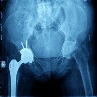 Psoriatic Arthritis Does Not Increase Risk of Poor Outcomes Following Hip Replacement