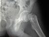 Osteoporosis Medicine can Cause Fractures