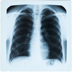 Respiratory Failure Deadlier When It Happens in Hospitals